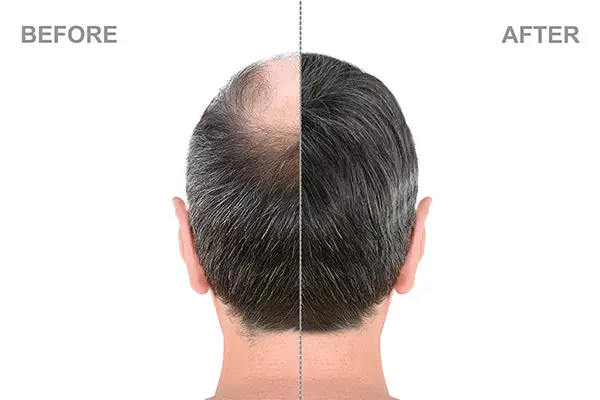 GlowUp Istanbul Hair Transplant Before and After